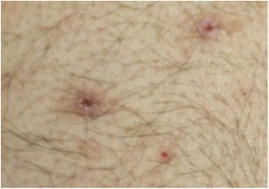 Umbilicated papules with central hemorrhagic crust.