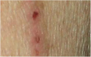 Linear distribution of some papules.