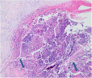 Collagen fibers traversing from the dermis through the ulcer to the surface (Hematoxylin & eosin, ×200).