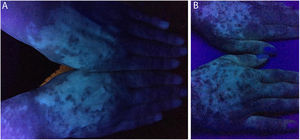 Patient's hands under Wood's lamp. (A) Prior to treatment, various white macules on both hands. (B) After two years of treatment, repigmentation improvement is noted on both hands.