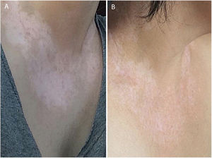 (A) Prior to treatment, various white macules. (B) After two years of treatment, repigmentation improvement is noted.