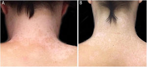 (A) Prior to treatment, numerous white macules. (B) After two years of treatment, repigmentation is nearly complete.