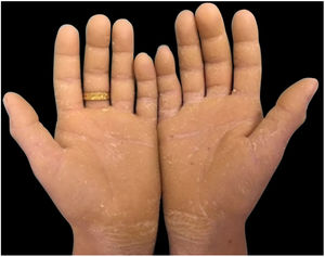 Hyperkeratosis in palms.