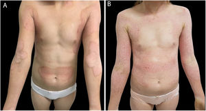 (A) Erythematous, keratotic plaques with prominent and geographical borders on the arms, forearms, cervical, armpits, lateral region of the trunk, and umbilical and supra-umbilical regions. (B) The same patient a month later, presenting erythematous and hyperkeratotic plaques along the entire arm, forearm, and anterior chest, sparing the umbilical and supra-umbilical regions.