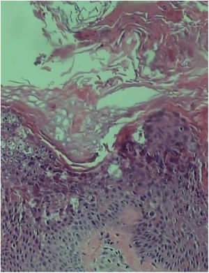 Acanthosis, papillomatosis, and hyperkeratosis with epidermolysis of the granular layer (Hematoxylin & eosin, ×400).