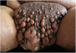 Multiple, grouped lesions of irregular size with purulent discharge.
