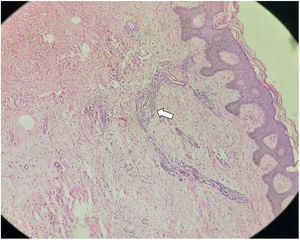 Proliferation of dilated lymphatic vessels with thin, irregular walls, lined by soft endothelial cells in the papillary dermis and with non-atypical lymphocytic aggregates; histopathology (Hematoxylin & eosin, x10).