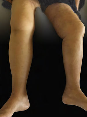 Cutaneous infiltration of the lower limbs, more extensive on the left side, and on the right side affecting the root of the thigh.