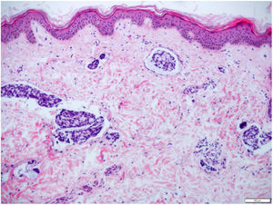 Presence of diffuse lymphatic embolization associated with dermal edema (Hematoxylin & eosin, x50).