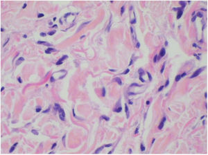 Characteristic irregular multinucleate cells of MCAH, typified by angular borders and multiple potentially hyperchromatic nuclei in the dermis and enlargement of endothelial nuclei in the capillaries (Hematoxylin & eosin, ×400).