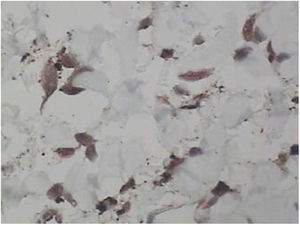 Immunohistochemistry study. Histiocytic and multinucleated cells are positive for Factor XIIIa (×400).