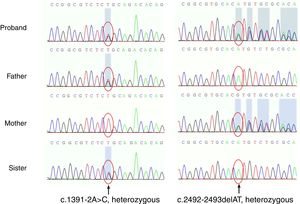 Two novel heterozygous variants in the RECQL4 gene confirmed by gene sequencing. One was in the splice site, c.1391-2A>C from her father, and also was seen in her sister. The other was a deletion mutation, c.2492_2493delAT (p.His831Argfs) from her mother.
