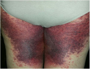 Purpuric and targetoid lesions in the thighs and the gluteal area.