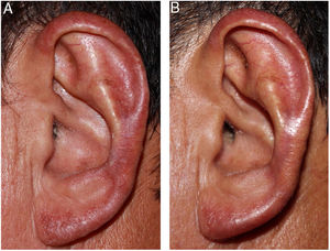 (A and B) After 25 days of treatment, and at the end of ten weeks.