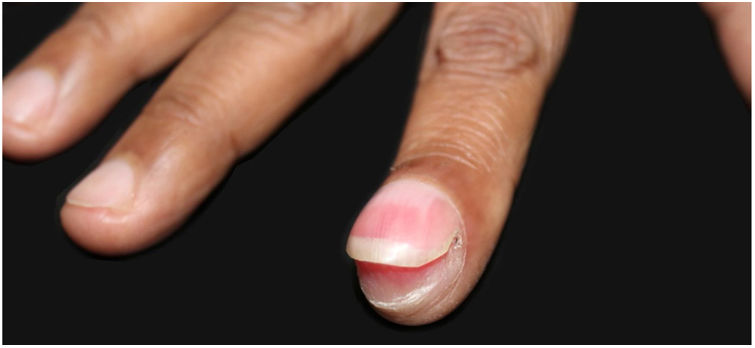 Case for diagnosis. Single-digit clubbing | Anais Brasileiros de ...