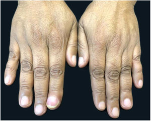 Increased volume of the second finger in the right hand.