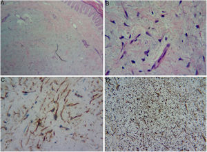 (A) Dermal proliferation of spindle and stellate cells without atypia, immersed in a myxoid stroma with moderate proliferation of small vessels. (B) Greater magnification showing the stellate cells. (C) Positive immunohistochemistry exam for CD34. (D) Positive immunohistochemistry exam for vimentin in the cytoplasm of all cells.