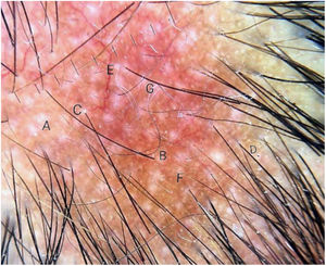Dermoscopy of the areas of non-cicatricial syphilitic alopecia. A, Empty hair follicles; B, Vellus hair C, Perifollicular hyperkeratosis; D, Black point on the periphery; E, Dilated and tortuous vessels; F, Erythematous-brownish background; G, Hypopigmentation of the hair shafts.