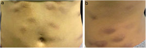 (A and B) Erythematous and infiltrated nodules in the abdomen.