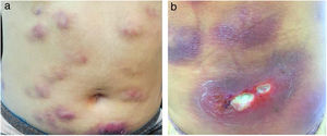(A and B) Erythematous and infiltrated nodules and plaques, some with ulceration and suppuration.