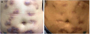 (A) Decreased inflammatory process after 2 months of antibiotic therapy. (B) Disseminated atrophic scars at the end of an 8-month course of treatment.