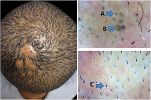 Early stage of dissecting cellulitis, with trichoscopy findings on alopecia areata. A, black dots; B, yellow dots; C, broken hair.