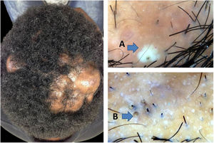 Abscedens stage of dissecting cellulitis. A, yellow structureless area; B, three-dimensional yellow dots.