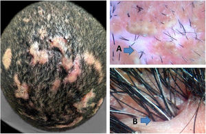 Fibrotic stage of dissecting cellulitis. A, lack of follicular openings; B, cutaneous clefts with emerging hairs.