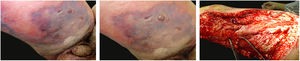 Necrotizing fasciitis. (A) Overview showing the extent of damage and different clinical stages. (B) Detail of the pale, erythematous-violaceous, painful devitalized area. Blister with hemorrhagic content and marginal erythema in the still viable area. (C) Demonstration of the necessary widening of surgical debridement.