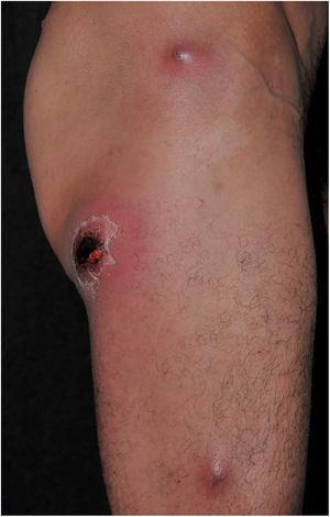 MRSA furunculosis. A healthy 42-year-old patient with several abscesses and furuncles. Positive culture for MRSA with production of Panton-Valentine leukocidin (PVL).