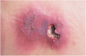 Carbuncle in a patient with insulin-dependent diabetes mellitus. An infiltrated erythematous-wine colored lesion, ulcerated with areas of necrosis and purulent secretion.