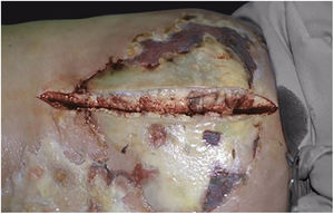 Necrotizing fasciitis of the medial aspect of the thigh with a consolidated, devitalized lesion; upon incision, almost no bleeding was observed due to thrombosis of the perforating vessels from the fascia to the epidermis.