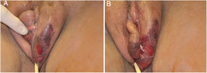 Fournier gangrene on the vulva after hair removal. Presence of edema, erythema, and signs of necrosis.