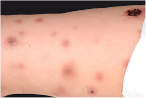 Ecthyma gangrenosum. Detail of the injury observed in Fig. 6. Presence of recent, clearly necrotic lesions.