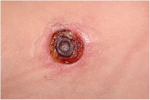 Ecthyma gangrenosum due to Pseudomonas aeruginosa. Detail of ulceronecrotic lesion and active border, erythematous-edematous, infiltrated.