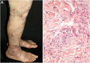 Cutaneous small vessel vasculitis limited to the skin: (a) palpable purpura and necrotic ulcers in the lower limbs; (b) necrosis of endothelial cells from superficial papillary dermis with fibrin deposition, neutrophil infiltration, and leukocytoclasia.