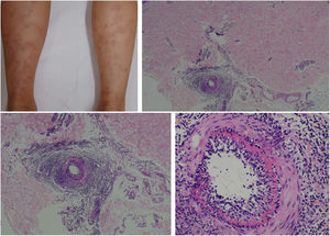 Macular lymphocytic arteritis (lymphocytic thrombophilic arteritis) showing livedo-type lesions without ulceration in the legs and the corresponding histopathological examination evidencing, at the dermo-hypodermic junction, an arterial vessel surrounded by lymphocytic infiltrate and with a fibrin ring in the intimal layer.