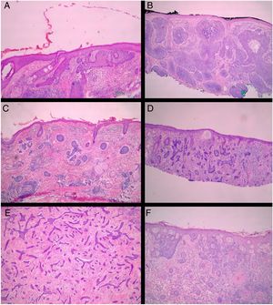 Histological subtypes of basal cell carcinoma. (A) Superficial; (B) Nodular; (C) Micronodular; (D) Infiltrative; (E) Morpheaform; (F) Metatypical. (Hematoxylin & eosin, ×40).