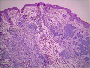 Mixed basal cell carcinoma composed of nodular and infiltrative subtypes. (Hematoxylin & eosin, ×10).