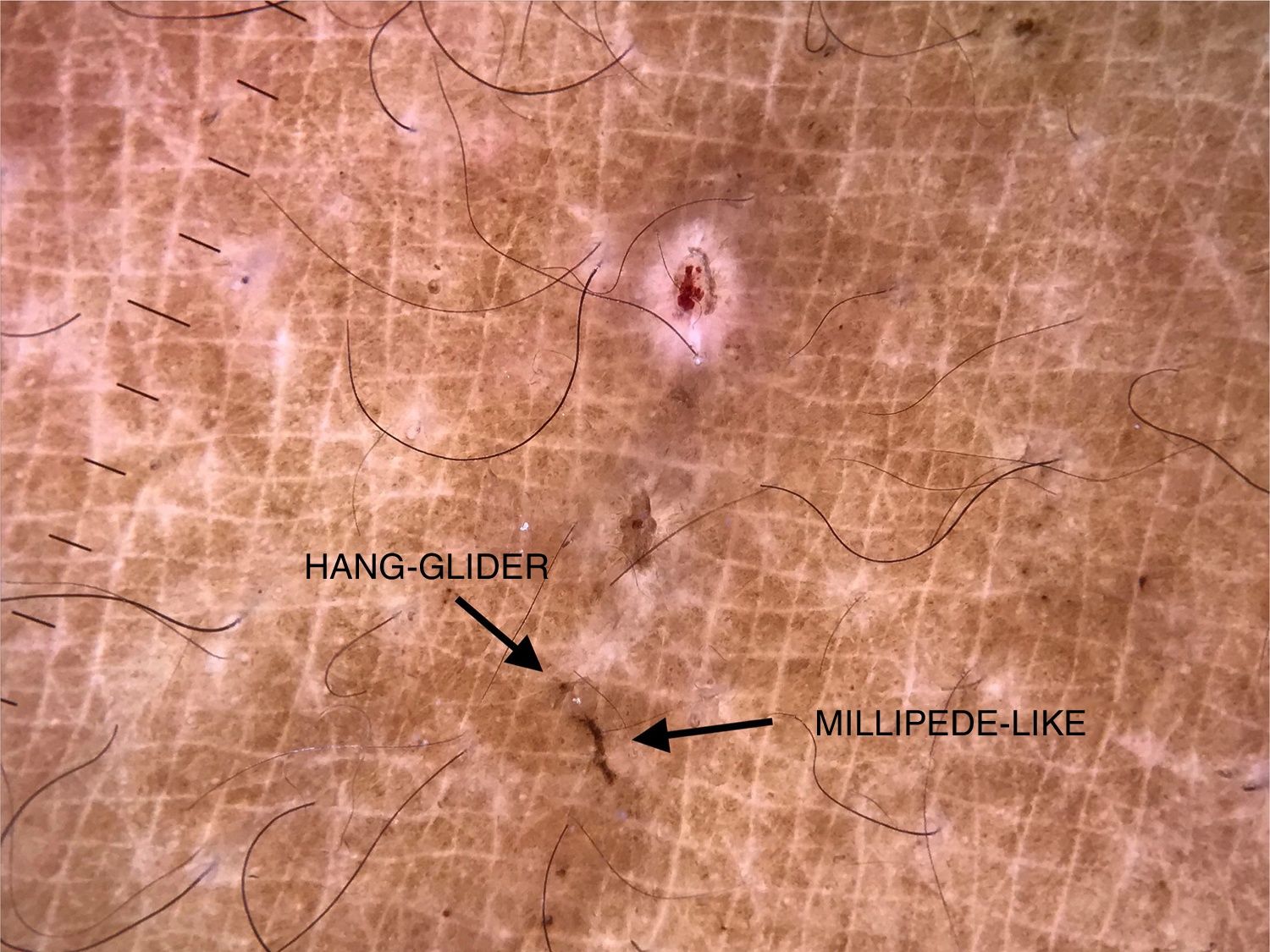 Digital dermoscopy: a complementary method in the diagnosis of scabies ...