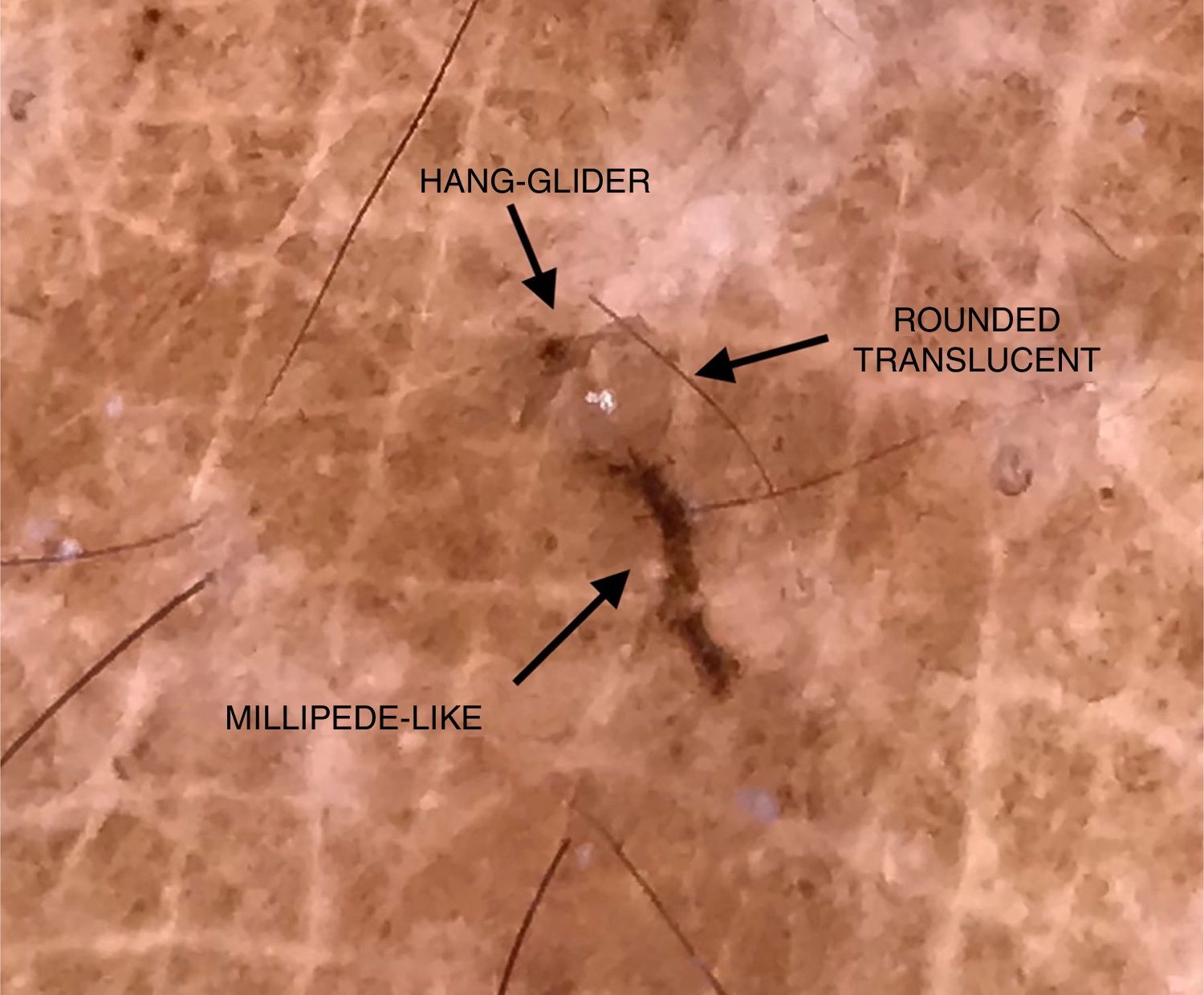 Digital dermoscopy: a complementary method in the diagnosis of scabies ...