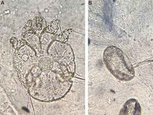 Observation of the mite (a) and eggs (b) in the direct examination (KOH 20%, ×100).
