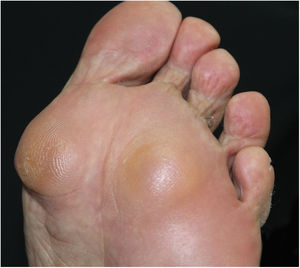 Detail of nodules in pressure areas of the plantar region.