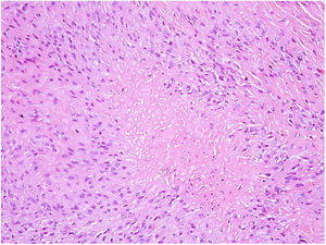 Granuloma with central necrosis surrounded by a palisade of epithelioid cells (Hematoxylin & eosin, ×100).