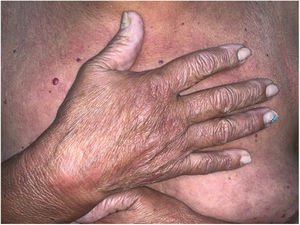 Erythematous plaques on the back of the hand and infiltration of the fingers.