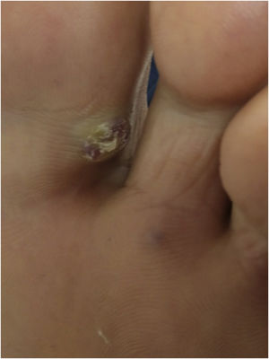 Violaceous papule with slightly verrucous surface in the interdigital space of the foot.