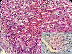 Histopathology revealed a fusocellular proliferation delineating elongated and branched vessels, extravasated red blood cells, frequent mitoses, and few cellular atypias. The immunohistochemical study in the inset.