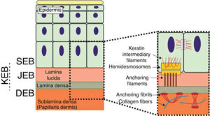 Schematic representation of the skin layers associated with the different types of epidermolysis bullosa (EB). In the epidermis, keratinocytes are depicted. The epidermis is attached to the dermis by the basement membrane, formed by the lamina lucida and lamina densa. On the left side of the figure, each type of EB is presented next to the respective skin layer in which the formation of blisters occurs. Cleavage in EB simplex (EBS) occurs within the basal keratinocytes; in junctional EB (JEB), within the lamina lucida; and in dystrophic EB (DEB) occurs in the sublamina densa, in the upper portion of the dermis (papillary dermis). In Kindler