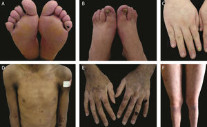 Clinical aspects of epidermolysis bullosa simplex (EBS). (A‒C) Plantar keratoderma, dystrophic and thick nails on the hands and feet of patients with localized EBS. (D‒F) Blisters and erosions distributed in a generalized way in patients with intermediate EBS. The presence of epidermolysis bullosa nevi is common in all subtypes of EBS.