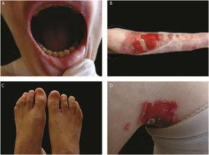 Clinical aspects of junctional epidermolysis bullosa (JEB). Dental enamel anomalies, chronic wounds, and absence of nails in a patient with severe JEB.
